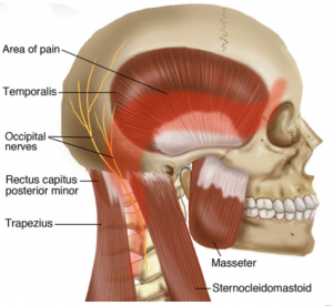 Figure 1 Tension Headaches