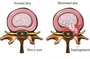 Herniated-disc-lower-back-pain