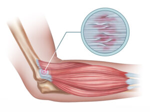 tennis elbow